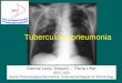Tuberculous pneumonia - ISR TB pneumonia.pdf · Tuberculous pneumonia (2) • The research of AFB is most often positive in sputum, because these lesions are very rich in tuberculous