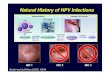Natural History of HPV Infections - SBMF · A administração profilática da vacina quadrivalente contra o HPV ... Revolta da Vacina, RJ (14/Nov/1904) ... Microsoft PowerPoint 