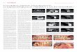 Il workflow digitale intraoperatorio in implantologia post ... Natale.pdf · logie accompagnano e scandisco - ... • Riduzione drastica dello stress crestale ... pianto da 10 mm