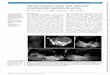 Infected transverse colonic cystic duplication simulating ... · 3 Piolat C, N’Die J, Andrini P, et al. Perforated tubular duplication of the transverse colon: a rare cause of meconium