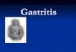 Gastritis - medsyllabus.org file1. Chemical gastritis (acute・chronic) Alcoholic gastritis Drug induced gastritis (e.g., NSAID) Reflux ( due to duodenal juice or bile) gastritis Other