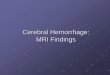 Cerebral Hemorrhage: MRI Findings - School of Medicinecasemed.case.edu/clerkships/neurology/Web Neurorad/Intracerebral... · Appearance on MRI is variable depending on: Field strength