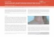 Yetişkin yaşta akut üst gastrointestinal sistem kanaması ...endoskopi.tgv.org.tr/journal/18/pdf/164.pdf · damar vaskülitidir (1,2,5). Gastrointestinal sistem HSP’nin deriden