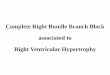 Complete Right Bundle Branch Block associated to Right ...cardiolatina.com/wp-content/uploads/2017/03/Complete-Right-Bundle-Branch-Block...Right Ventricular Hypertrophy. V 6 V 1 X