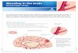 Bleeding in the brain - chumontreal.qc.ca brain... · This type of stroke is caused by bleeding (hemorrhage) in the brain. It causes brain cells to die because of: ... will encourage