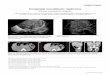 Congenital mesoblastic nephroma - Albert Einstein Hospitalapps.einstein.br/revista/arquivos/PDF/1495-Einsteinv7n4p529-31.pdf · Congenital mesoblastic nephroma, also known as fetal