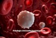 Patologia sistemului hematopoietic. · Ficatul în leucoza limfoidă cronică. (ColoraţieH-E.). Indicaţii: 1. Focare de proliferare a celulelor tumorale de origine limfoidă pe