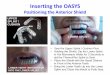 Inserting the OASYS - Oasys Sleep the OASYS.pdf · Inserting the OASYS Positioning the Anterior Shield • Seat the Upper Splint / Cushion First • Holding the Shield, Dip the Lower