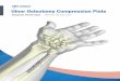 Ulnar Osteotomy Compression Plate - TriMed Inc. · Ulnar Osteotomy Compression Plate UOCP • A 1.6mm K-wire or the Bone Clamp can be used to stabilize the cutting guides to the plate