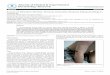 l Journal of Clinical & Experimental Dermatology …...A Case of Mistaken Identity: Henoch-Schonlein Purpura Masquerading as Urticaria Katerina Yale1, Kathleen Ellison2 and Kalyani