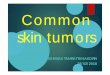 Common skin tumors - Mahidol University...Pearly penile papule Acral fibrokeratoma Dermatofibroma Hyperpigmented firm papule 0.5-2 cm. Dermatofibroma Lipoma Lipoma : most common soft-tissue