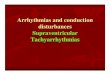 Arrhythmias and conduction disturbances Supraventricular ... Mobitz type I block Caused by conduction delay in the AV node in 72% of patients and by conduction delay in the His -Purkinje