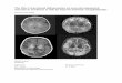 The effect of perinatal inflammation on neurodevelopmental ...scripties.umcg.eldoc.ub.rug.nl/FILES/root/geneeskunde/2012/JensterM/JensterM.pdfThe clinical presentation of HIE varies