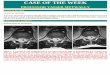 CASE OF THE WEEK - WordPress.comfollowing varicella infection. [139] Post-immunization BRPIND occur most frequently following measles, rubella, or mumps vaccination. Many vaccines