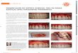 A L R TIGO O R I G I N REMODELAÇÃO DO BIÓTIPO GENGIVAL ...³pia.pdf · lógico de regeneração periodontal constituído por proteínas derivadas da matriz de esmalte (EMDOGAIN®)
