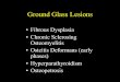 HF. GROUND GLASS...Ground Glass Lesions • Fibrous Dysplasia • Chronic Sclerosing Osteomyelitis • Osteitis Deformans (early phases) • Hyperparathyroidism • Osteopetrosis