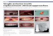CLINICAL Single anterior tooth replacement: clinical ...barkerpr.com/wp-content/uploads/2014/06/IDT-Sep-Swanson.pdf · CLINICAL. Single anterior tooth replacement: clinical approaches