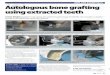 IMPLANT ESSENTIALS Autologous bone grafting using …...In immediate placement cases, the graft can be prepared while the implant is placed. It is recommended that the implant be placed