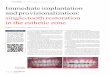 C.E. article immediate implantation and provisionalization ... · followed by implant placement, healing while wearing the flipper and, finally, restoration of the implant. The best