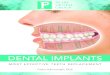 MOST EFFECTIVE TEETH REPLACEMENT - Pearl …...implant-retained dentures, these implants firmly affix artificial teeth to dental implant posts for ease of use, greater comfort, and