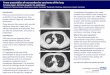 A new presentation of neuroendocrine carcinoma of the lung · A new presentation of neuroendocrine carcinoma of the lung Dr Aisling Fagan1, Mr Patrick Coughlin1, Dr Judith Babar2