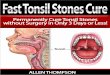 Fast Tonsil Stones Curehowtocuretonsilstones.com/.../FastTonsilStonesCure.pdf · Fast Tonsil Stones Cure HowtoCureTonsilStones.com 9 The Symptoms of Tonsil Stones Those with small