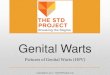 Genital Warts - The STI Projectthestiproject.com/.../07/std_pictures_genital_warts...THE STD PROJECT Breaking the Stigma . virus . Title: Chancroid Author: Do Not Use Created Date: