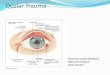Ocular Trauma - كلية الطب · Penetrating trauma when a foreign body passes through the ocular coat of the eye, this will cause damage in the ocular structures, and in some
