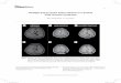Multiple Intracranial Tuberculomas in a Patient With ... · has paradoxical development of intracranial tuberculomas during treatment of miliary pulmonary tuberculosis. This phenomenon