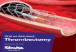What we think about: Thrombectomy · What we think about: Thrombectomy 2 Thrombectomy or mechanical thrombectomy is a relatively new procedure used to treat some ischaemic stroke
