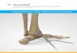 4.7 mm and 5.5 mm Screws - Acumed · Acutrak 2® Headless Compression Screw System Supplemental Use Guide—Medial & Lateral Malleolus 4.7 mm and 5.5 mm Screws