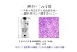 ～多彩な病態を示す造血器腫瘍～ ―節外性リンパ腫 …...12)セザリー症候群 13)原発性皮膚CD30陽性T細胞増殖性疾患 9)粘膜関連濾胞辺縁帯リンパ腫(MALT