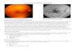 Retina Eye diseases/Non-Proliferativ… · Web viewThere are two main types of diabetic retinopathy; non-proliferative diabetic retinopathy and proliferative diabetic retinopathy