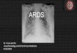 ARDSorhb.gov.et/images/covid/.../11_.Dr._Tura_ARDS_and...Diagnosis ARDS can be diagnosed once cardiogenic pulmonary edema and alternative causes of acute hypoxemic respiratory failure
