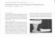 Partial Foot Prostheses/Orthoses - Partial Foot Prostheses/Orthoses by Melvin L. Stills, CO. Introduction