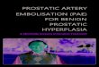 PROSTATIC ARTERY EMBOLISATION (PAE) FOR BENIGN ¢  Benign Prostate Hyperplasia (BPH) is the most common