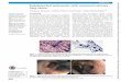 Images in Endobronchial anthracosis with concurrent ...€¦ · (EBUS-FNA) demonstrating black pigmentation of anthracotic macrophages on a background of lymphocytes; 40× (A) and