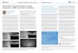 Case Report: MicroPulse Laser Therapy Real-World Solutions · 2015-11-22 · (CRT). I’m more likely to use anti-VEGF first and add MicroPulse later, if necessary, in patients with