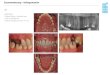 1967 Hauptprobleme: •Fehlende Molaren im Oberkiefer rechts ... · 3.2 Dental • Zahn 14: insufﬁziente Wurzelbehandlung, Parodontitis apicalis, insufﬁziente Krone • Restgebiss