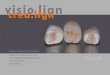 crea - visio.lign...Inlay, onlay, overlay Situación de partida Acondicionamiento de los dientes: inlay MOD sobre 25, corona completa sobre 26 e inlay sobre 27. Detalle de la impresión