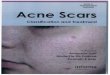 Dermatologist West Palm Beach - Jupiter | Beer Dermatology · acne scars, deeper and broader scars may be treated effectively with ablative devices capable of resurfacing to a deeper