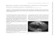 Retinal vascular remodelling in radiation retinopathyretinopathy,orsystemichypertension,tonamesome of the more common aetiologies. Interestingly, retinal vascular disease-for example,