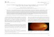 Case Report Case of Bilateral Retinal Neovascularization ...€¦ · Case Report Case of Bilateral Retinal Neovascularization Associated with Chronic Idiopathic Myelofibrosis Moon