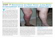 We Know Veins · increased pressure in the veins in the lower legs and feet which causes veins just under the skin to bulge (varicose veins) and water and protein to leak out into