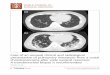 presentation of pulmonary metastasis from a costal · 2017. 8. 26. · CASE REPORT Open Access Case of an unusual clinical and radiological presentation of pulmonary metastasis from