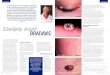 Piše: Mateja Lisjak, Zdravljenje virusnih BRADAVIC · 2021. 1. 13. · Ploščate bradavice Seboroičnakeratoza (starostna bradavica) Zdravljenje virusnih BRADAVIC V irusne bradavice