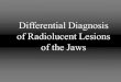 Differential Diagnosis of Radiolucent Lesions of the Jaws...Periapical Radiolucencies • Endodontic Apical Lesions – Granuloma, Abscess, Cyst • Traumatic Bone Cyst • Incisive