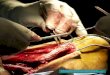 US Air Force surgeons repair the ruptured achilles tendon of a ...n Achilles tendon injury, whether it’s a tear or complete rupture, can be caused by a direct trauma, a laceration