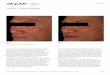 Level 3 Resurfacing - urepublic.com.au · The BBL-ProFractional combination is best suited for more severe forms of pigment blemish. Please refer to the patient information on the