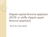 Slipped capital femoral epiphysis (SCFE or skiffy, slipped ......(SCFE or skiffy, slipped upper femoral epiphysis) Done by : Yara Saleh outlines 1- Definition 2-Epidemiology 3-Presentation